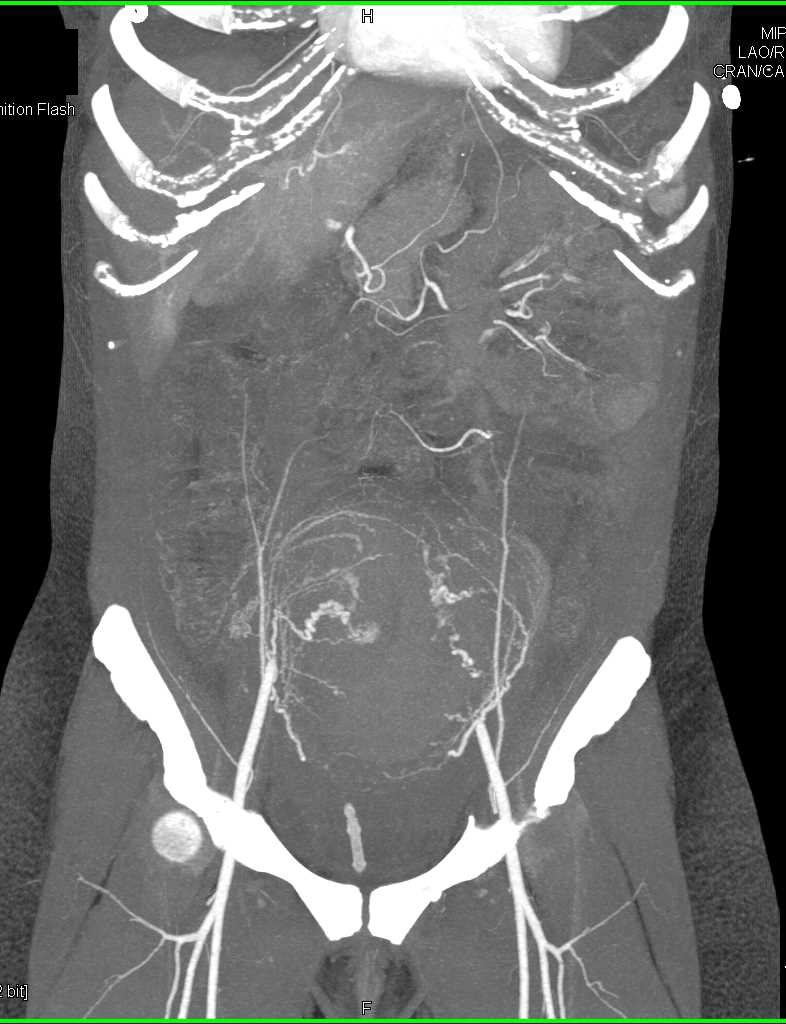 Postpartum Uterus with Bleed - CTisus CT Scan