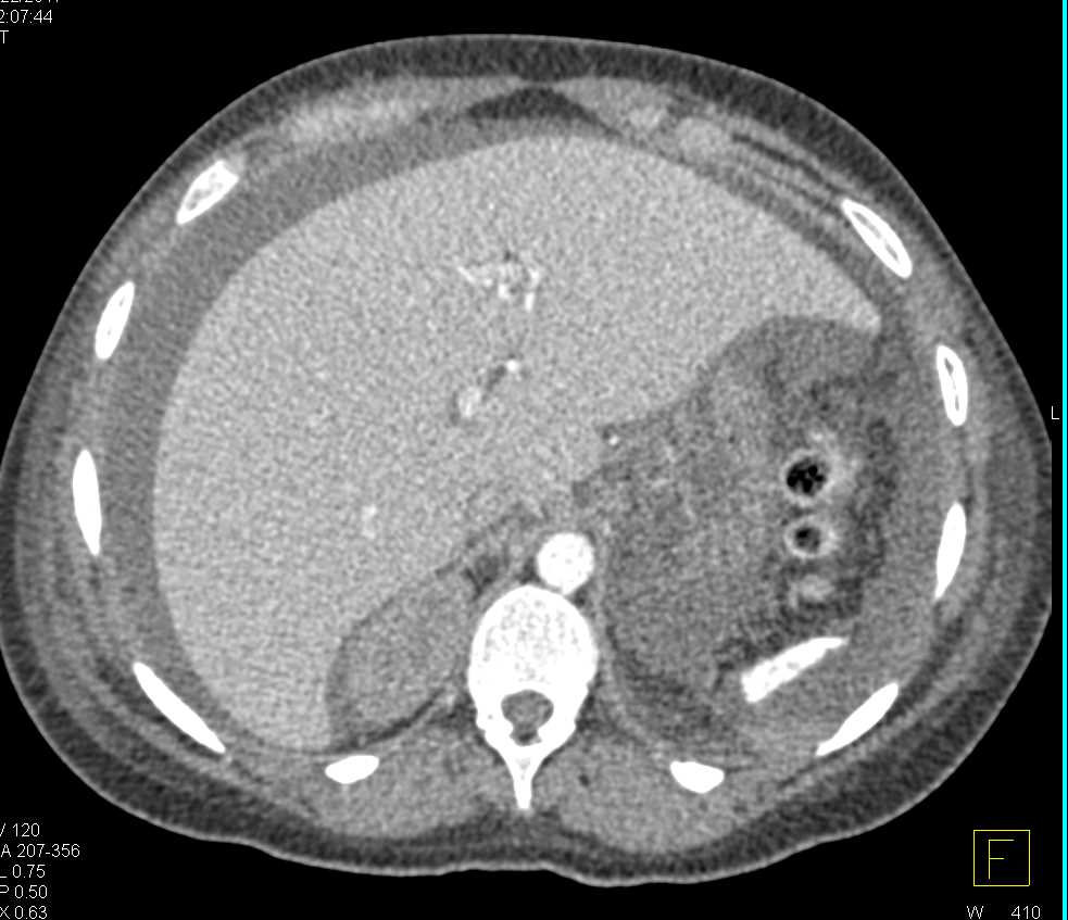 Ovarian Cystadenocarcinoma with Carcinomatosis - CTisus CT Scan