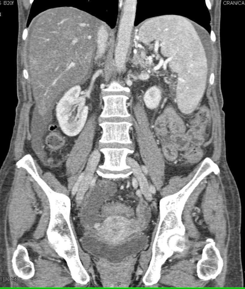 Ovarian Cystadenocarcinoma - CTisus CT Scan