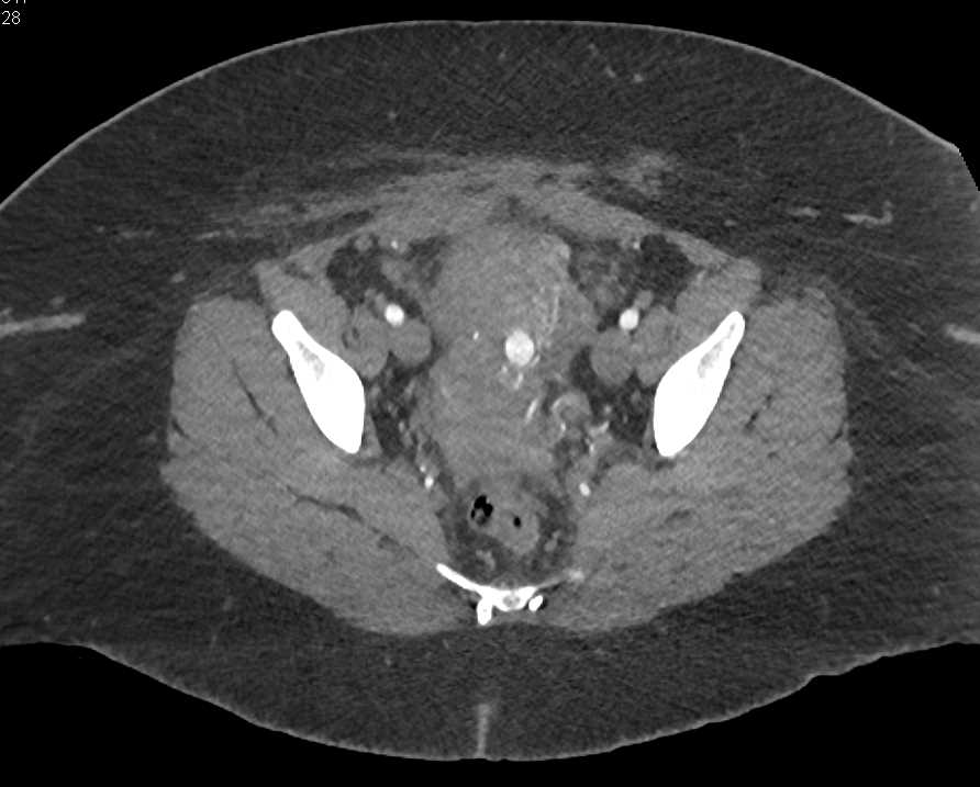 Intrauterine Bleed in Patient Postpartum - CTisus CT Scan