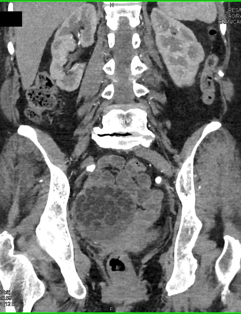 Harvesting Eggs for Fertilization - CTisus CT Scan
