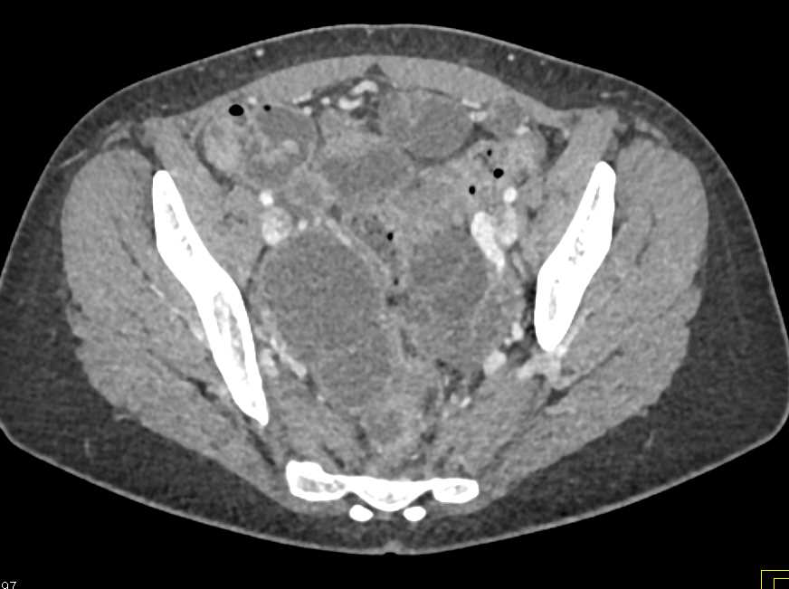 Pelvic Inflammatory Disease (PID) with Tubo-Ovarian Abscesses - CTisus CT Scan