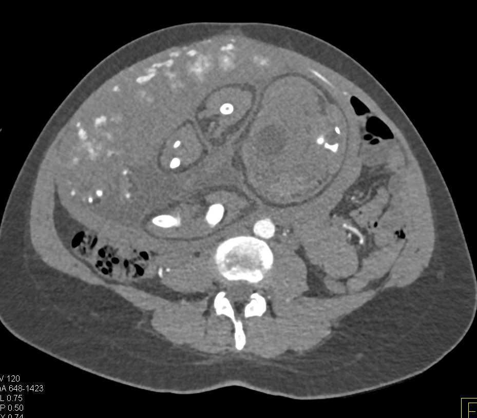 Perfusion Changes in the Fetus in a Patient Post Trauma - CTisus CT Scan