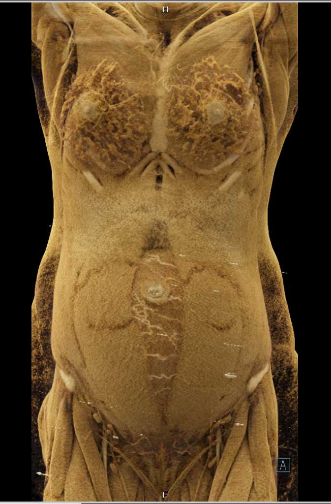 Pregnancy with Vascular Placenta - CTisus CT Scan
