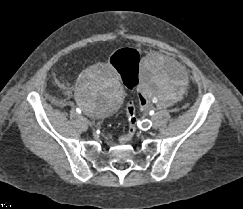 Carcinomatosis with Metastases to the Ovaries - CTisus CT Scan