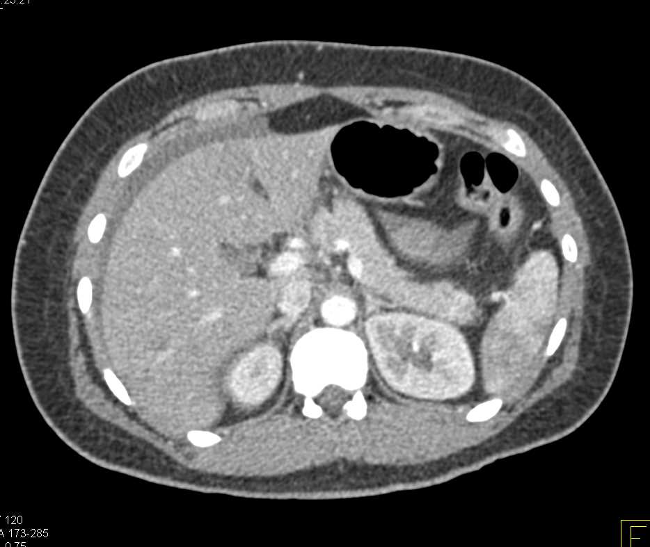 Post Partum Bleed - CTisus CT Scan