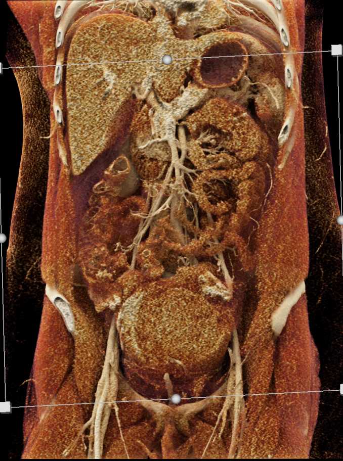 Post Partum Bleed - CTisus CT Scan