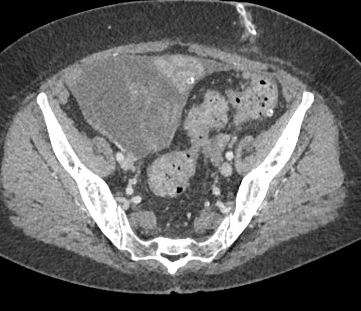 Ovarian Cancer with Carcinomatosis - CTisus CT Scan