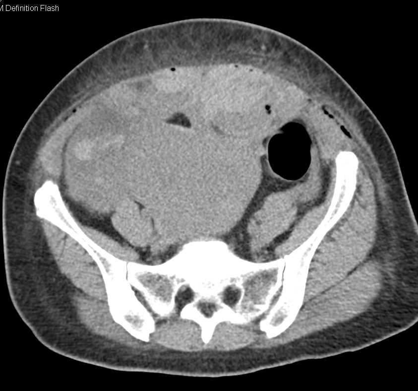 Post C-Section Bleeds - CTisus CT Scan