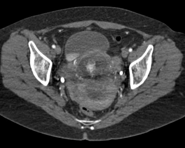 Bleed Within the Cervix - CTisus CT Scan