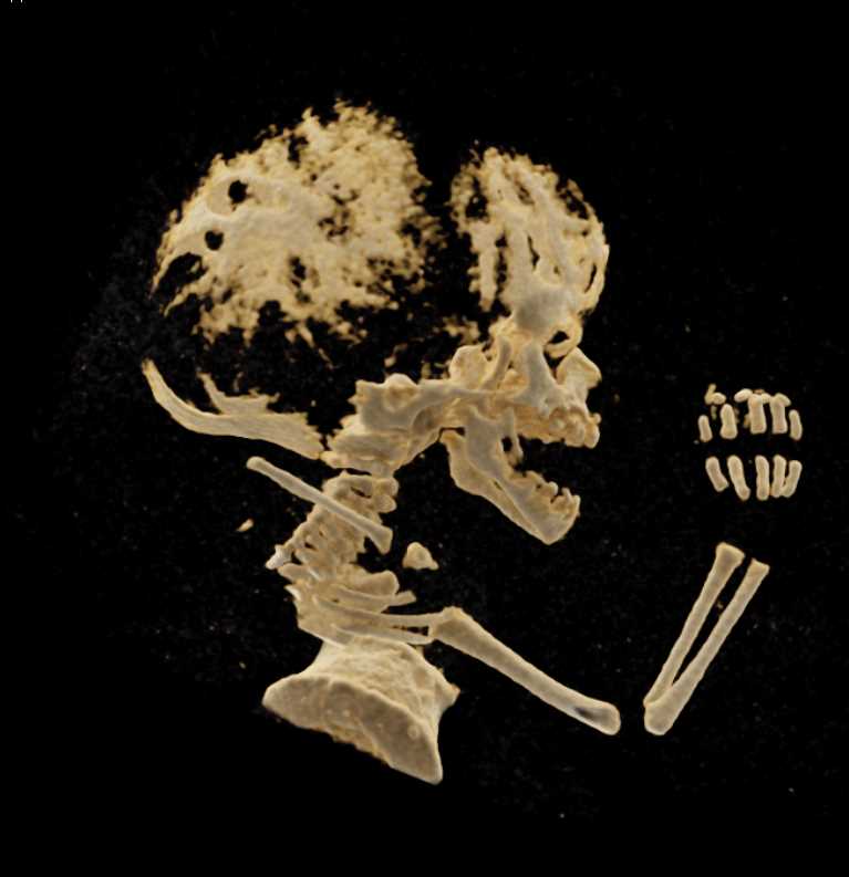 CT Fetus with Skeletal Dysplasia - CTisus CT Scan