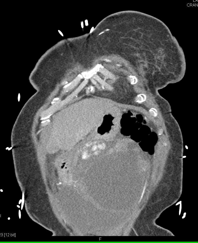 Ovarian Cancer - CTisus CT Scan