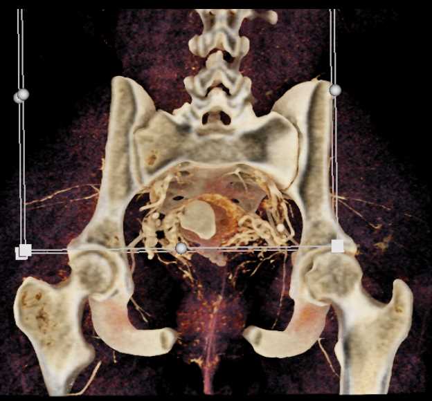 Pelvic Bleed - CTisus CT Scan