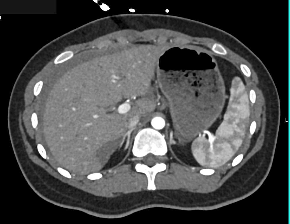 Torsed Ovary with Bleed - CTisus CT Scan