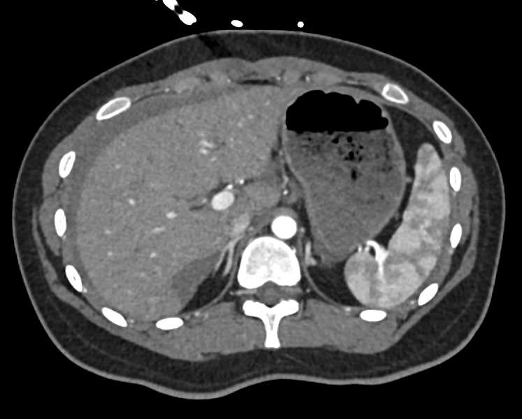 Torsed Ovary with Bleed - CTisus CT Scan