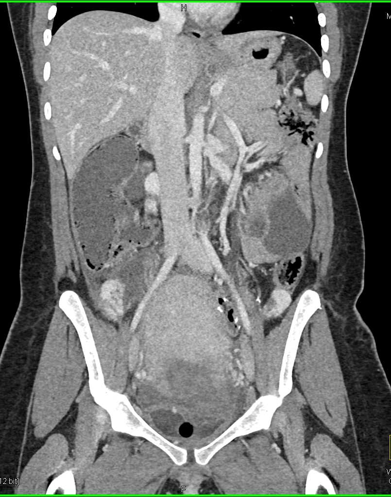 Uterine Injury Post Delivery - CTisus CT Scan