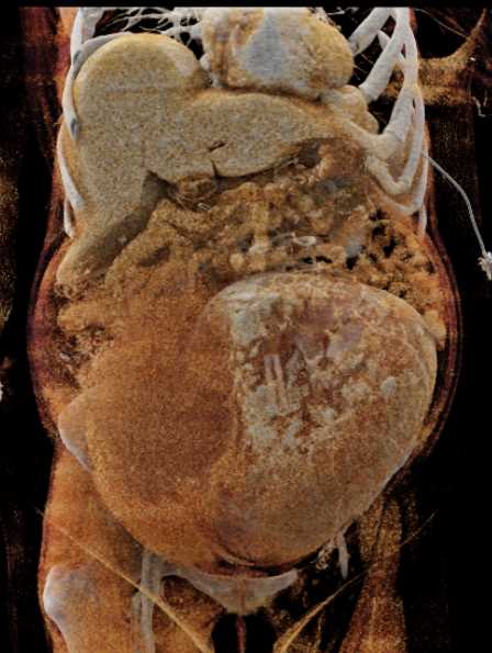 CTisus CT Scanning | Rectus Sheath Hematoma in a Pregnant Patient
