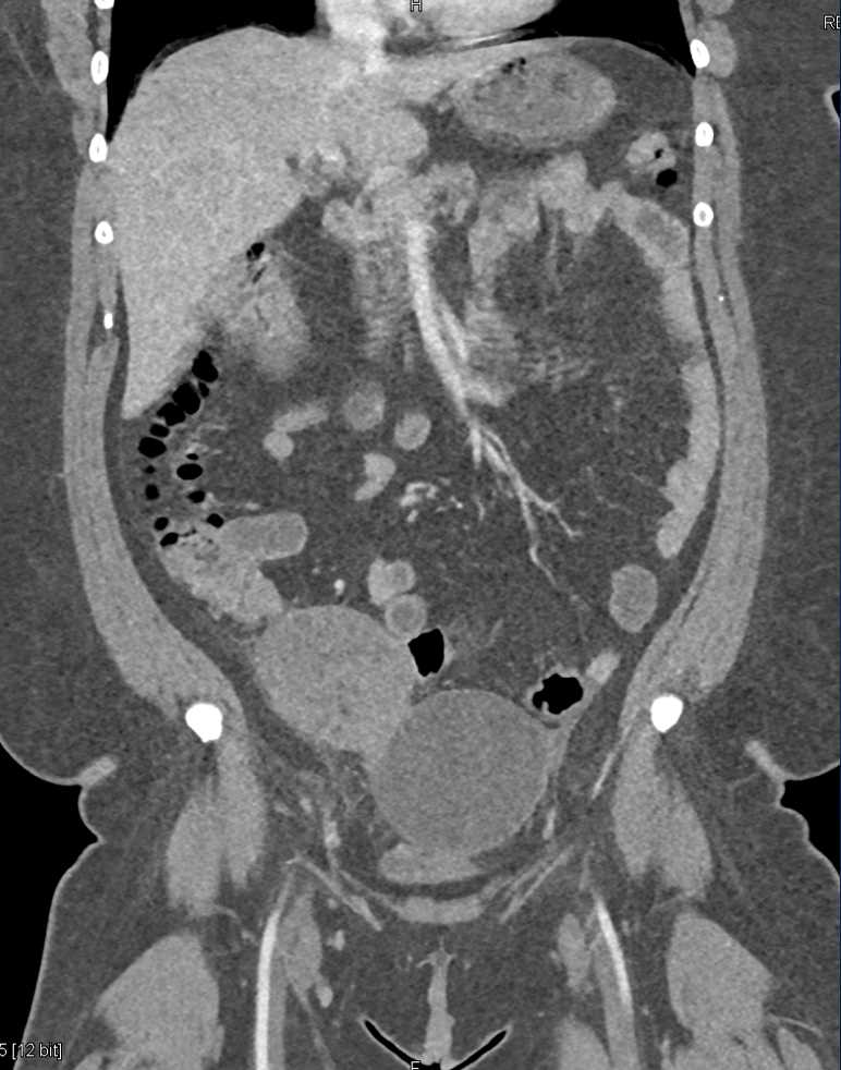 Torsion of the Right Ovary - CTisus CT Scan