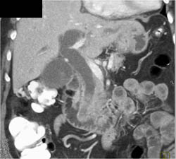Stones in Distal Common Bile Duct (CBD) - CTisus CT Scan