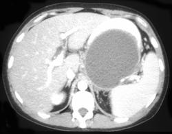 Large Pseudocyst - CTisus CT Scan