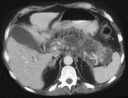 Pancreatic Abscess - CTisus CT Scan