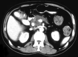Carcinoma of the Pancreas- Post ERCP - CTisus CT Scan