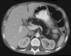 Cystic Fibrosis - CTisus CT Scan