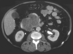 Cystadenoma of the Pancreas - CTisus CT Scan