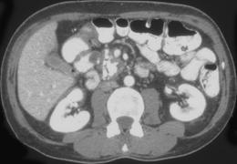 Pancreatic Cancer Arising in A Patient With Chronic Pancreatitis - CTisus CT Scan