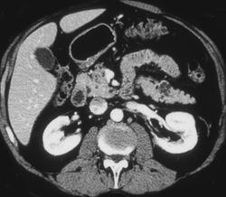 Small Cysts in Uncinate Process and Tail of Pancreas - CTisus CT Scan