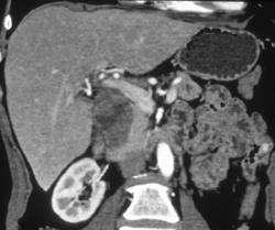 Acinar Tumor of the Pancreas - CTisus CT Scan