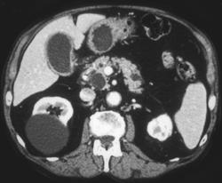 Multiple Mucinous Tumors of the Pancreas (Intraductal Papillary Mucinous Tumor (IPMT)) - CTisus CT Scan