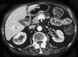 Cystadenoma of the Pancreas - CTisus CT Scan
