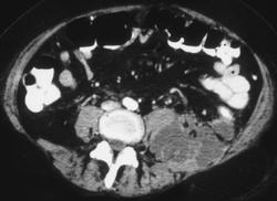 Acute Pancreatitis With Involvement of the Anterior and Posterior Pararenal Space - CTisus CT Scan