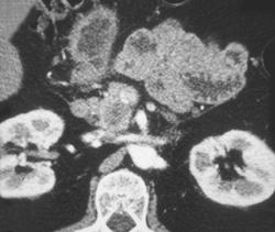 2 Cm Cancer of the Pancreatic Head - CTisus CT Scan