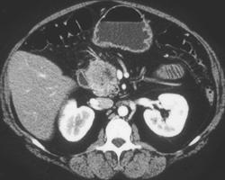 Subtle Carcinoma of the Pancreatic Head - CTisus CT Scan