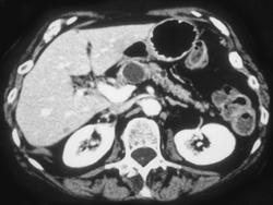 Cystadenoma - CTisus CT Scan