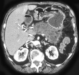 Intraductal Papillary Mucinous Tumor (IPMT) Infiltrates the Entire Pancreas - CTisus CT Scan