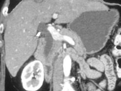 Distal Common Bile Duct Tumor - CTisus CT Scan