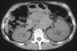 Recurrent Pancreatic Cancer With Nodule in Right Lower Lung Also - CTisus CT Scan