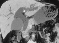 Minimum Intensity Projection and Volume Rendering of Dilated Common Duct - CTisus CT Scan