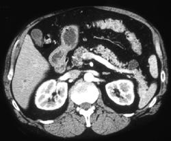 Intraductal Papillary Mucinous Neoplasm (IPMN) - CTisus CT Scan