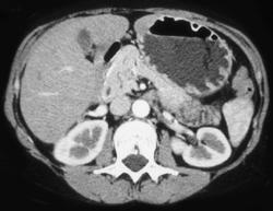 Gastrinoma With Only Lesion in Liver - CTisus CT Scan