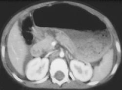Pancreatic Laceration Due to Trauma - CTisus CT Scan