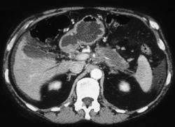 Pancreatic Cancer W/ Omental Implants - CTisus CT Scan