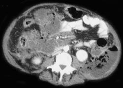 Pancreatic Abscess With Phlegmon - CTisus CT Scan
