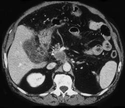Pancreatic Cancer With Extension Into Porta - CTisus CT Scan