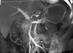 Pancreatic Cancer Invades the SMV/PV - CTisus CT Scan