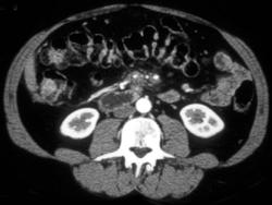 Pancreatic Cancer Invades the SMA - CTisus CT Scan