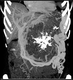 Serous Cystadenoma - CTisus CT Scan